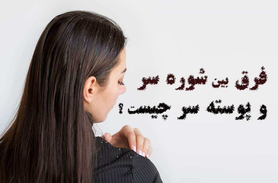 تفاوت شوره سر با پوسته سر چیست؟