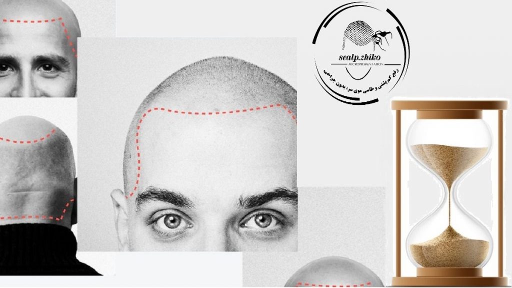 ماندگاری میکرواسکالپ سر
