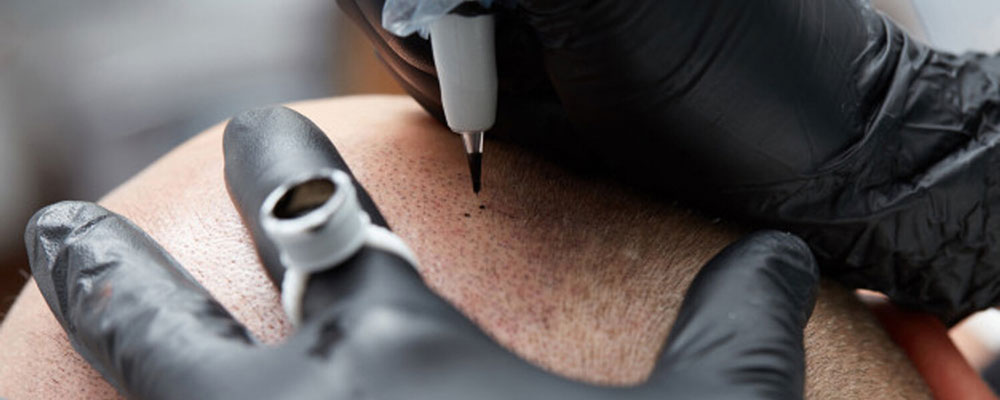 جدیدترین روش درمان آلوپسی