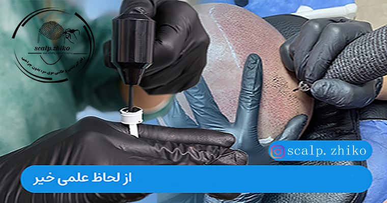 آیا میکرواسکالپ باعٍث ریزش مو میشود؟